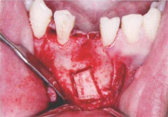 颏部自体块状骨移植联合GBR二期种植修复下前牙